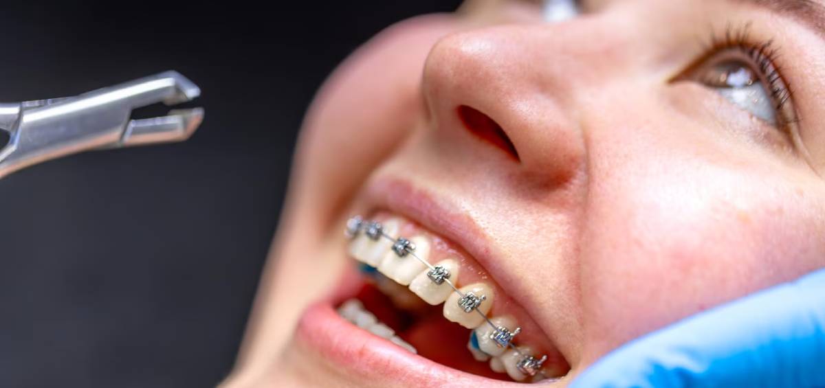 Top 5 reasons why Teenagers should opt Invisalign TEEN over Fixed Braces.