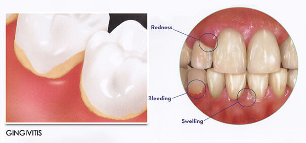 GINGIVITIS