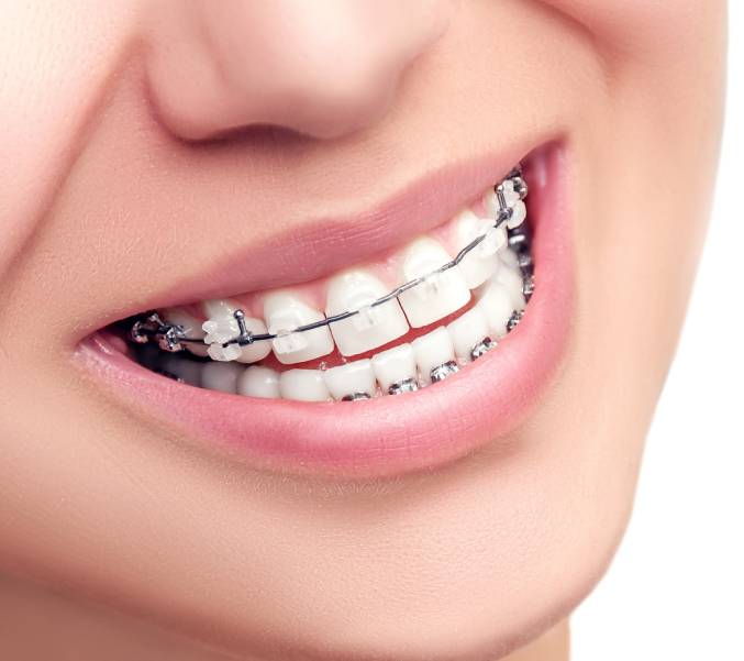 Ceramic Braces Treatment Cost in Gurgaon, Dental Braces Cost in