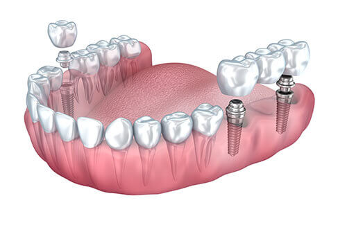 Dental Implant Treatment