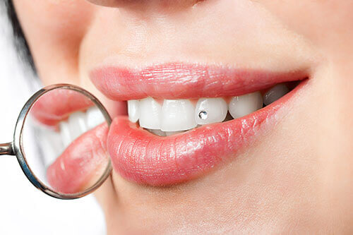 Dental Jewellery