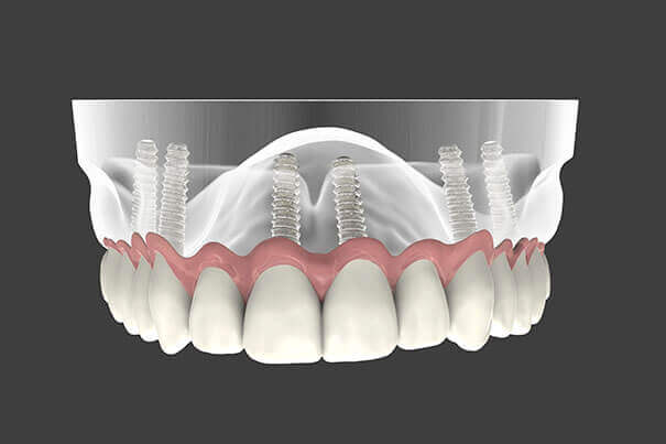 Full Mouth Rehabilatation