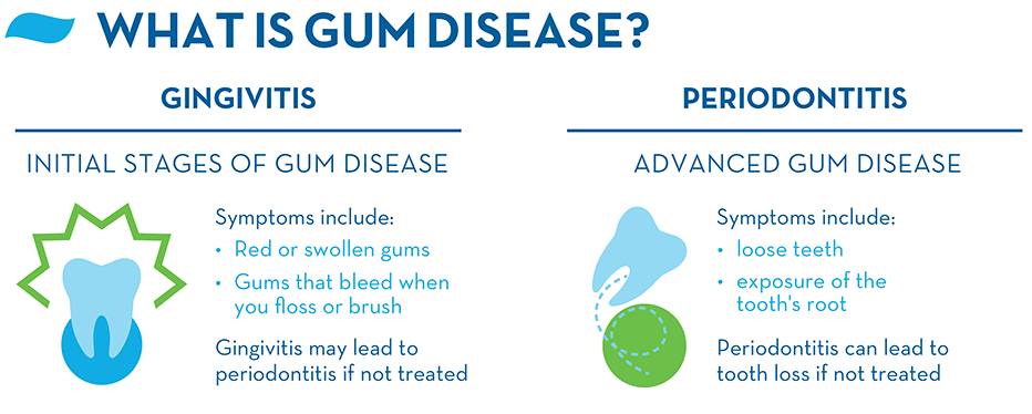 gingivitis-periodontitis