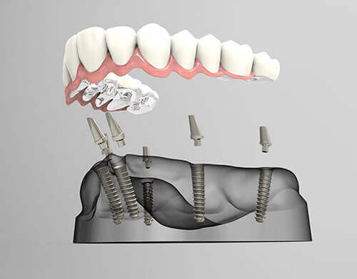 Dental Implant