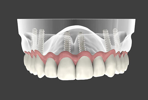 Implant Supported Full Mouth Prosthesis