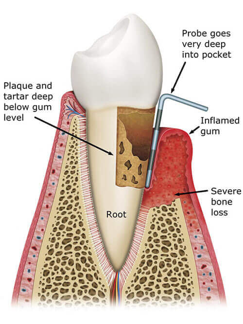 Periodontitis