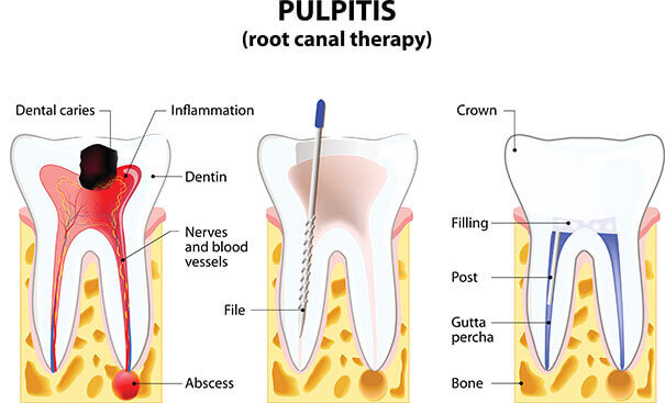 Root Canal Treatment Near You