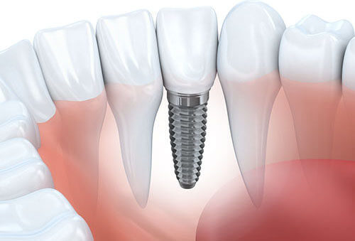 Tooth Implant With Crown