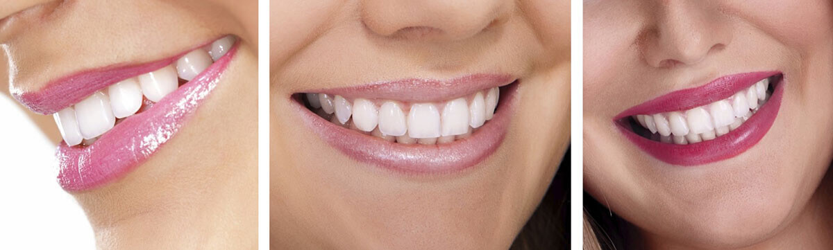 Teeth Whitening Treatment