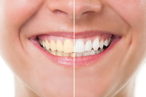 Teeth Whitening Treatment