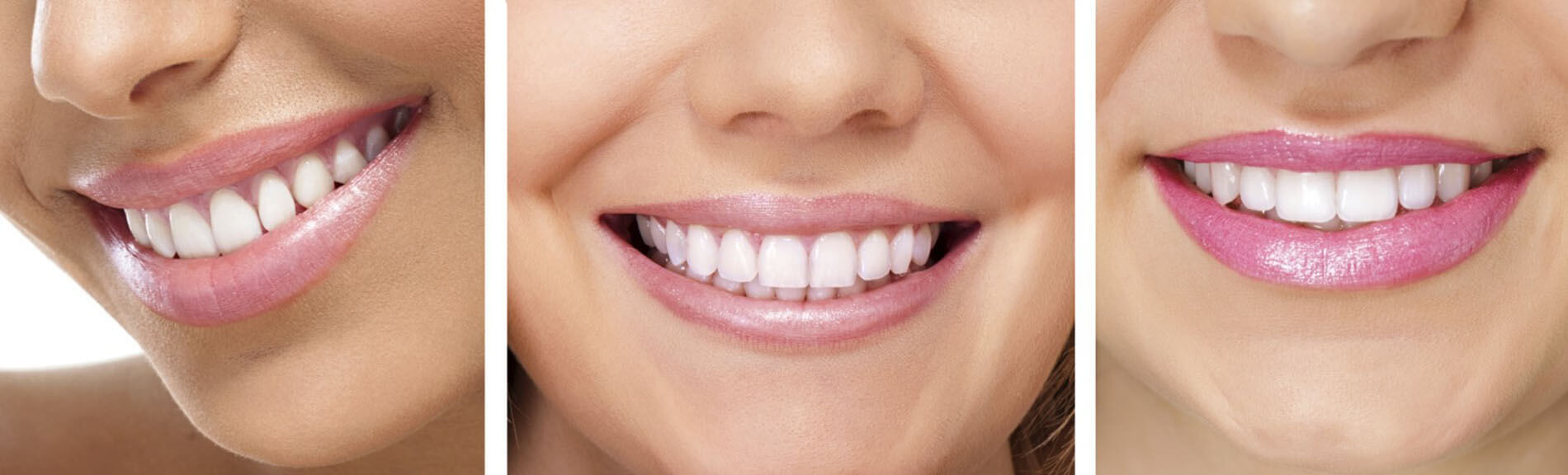 Быть идеально ровной. Идеальные зубы. Красивые ровные зубы. Красивая форма зубов. Красивые правильные зубы.