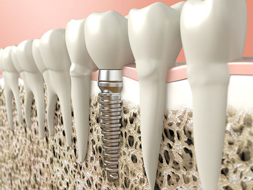 Dental Implants Clinic in Gurgaon